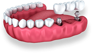 dental bridge jaw graphic