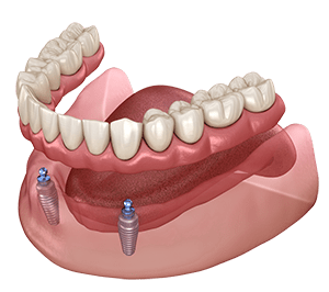 implant supported denture graphic