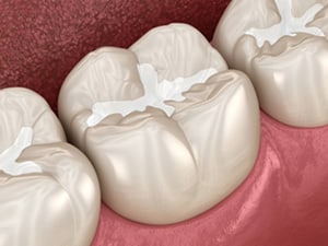 dental sealant teeth