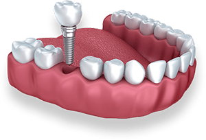 dental implant jaw graphic